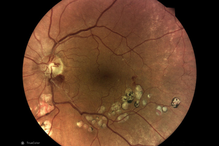 picture of retina using iCare technology